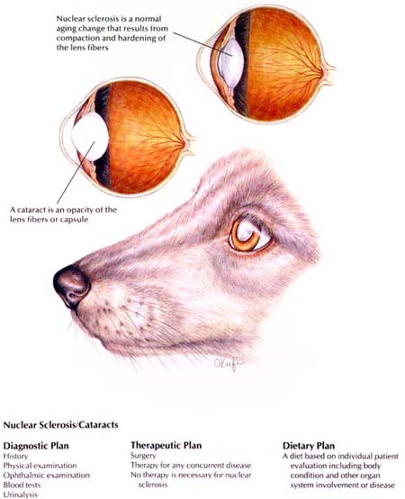 Nuclear Sclerosis/Cataracts