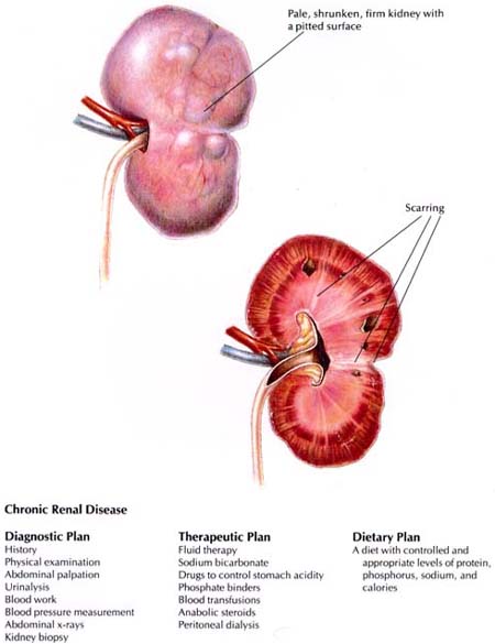 Chronic Renal Disease