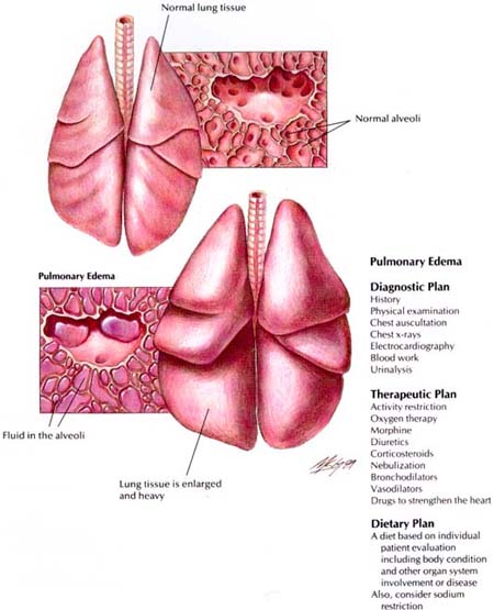 Pulmonary Edema