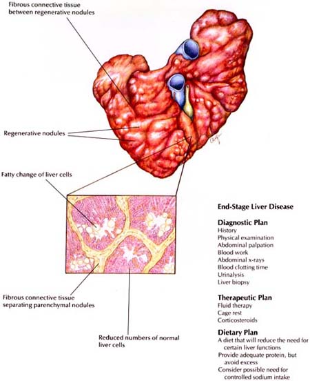 End-Stage Liver Disease