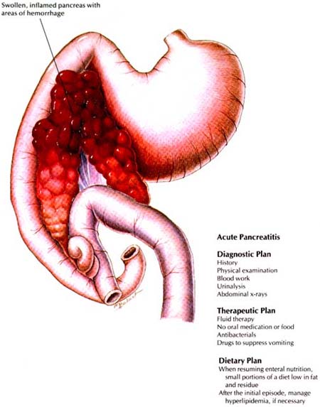 Acute Pancreatitis